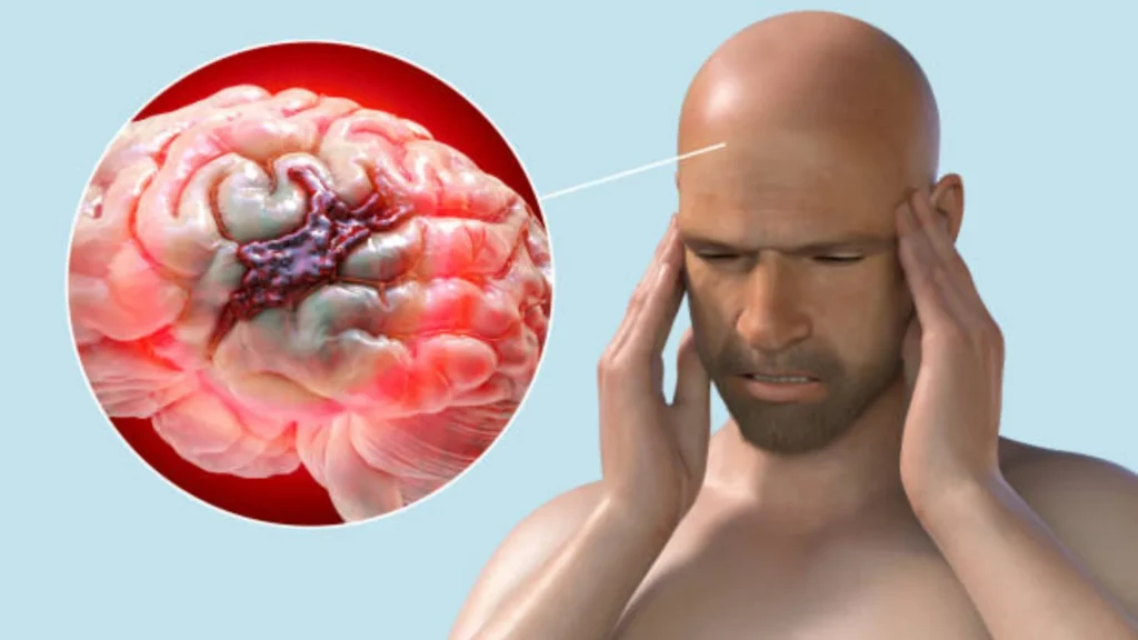 Brain  Tumors