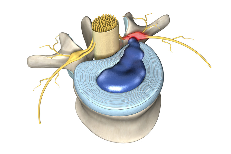 Cervical Disc Bulge