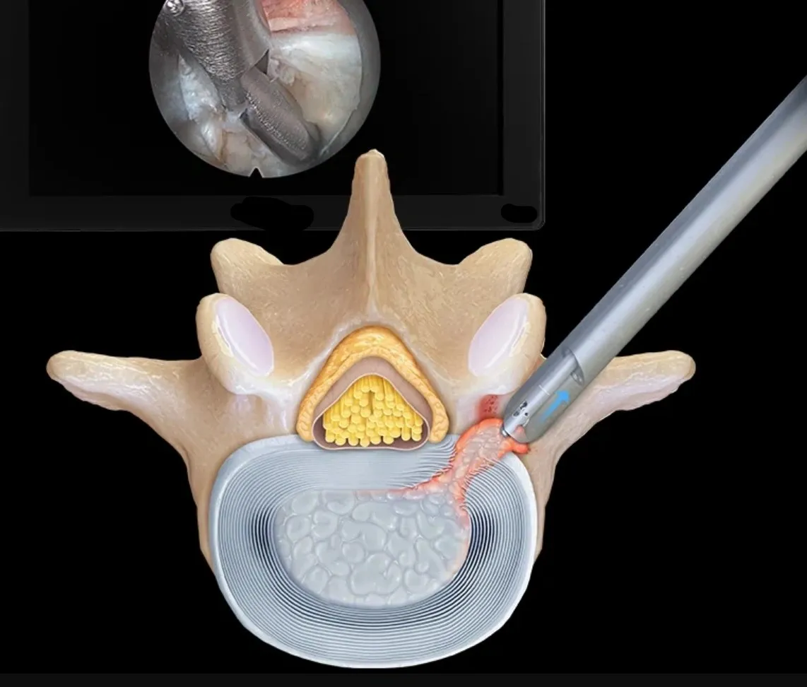 Endoscopic Spine Surgery