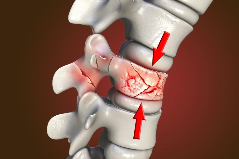 Spine Fractures